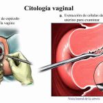 Sepa cómo se realiza una prueba de Papanicolaou