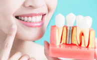 ¿Cuándo es necesario ponerse un implante dental?