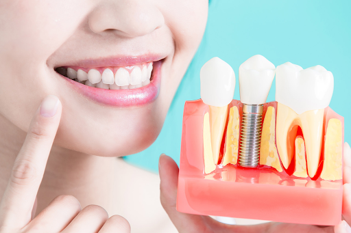 ¿Cuándo es necesario ponerse un implante dental?